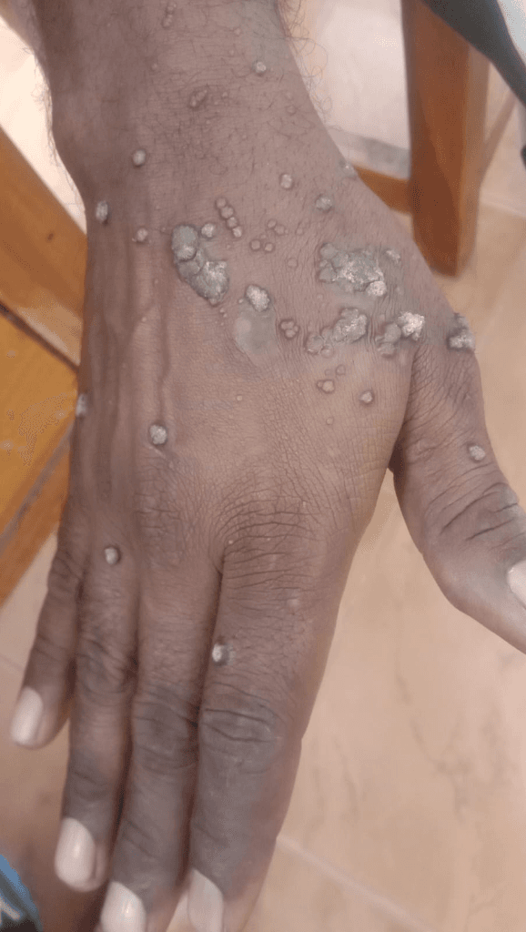 Extensive Hand Warts (Verruca Vulgaris) Clearance - Before Homeopathy Treatment