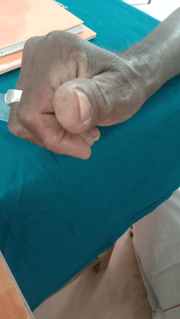 Thumb Pulp Ulceration & Severe Paronychia Healing - After Homeopathy Treatment
