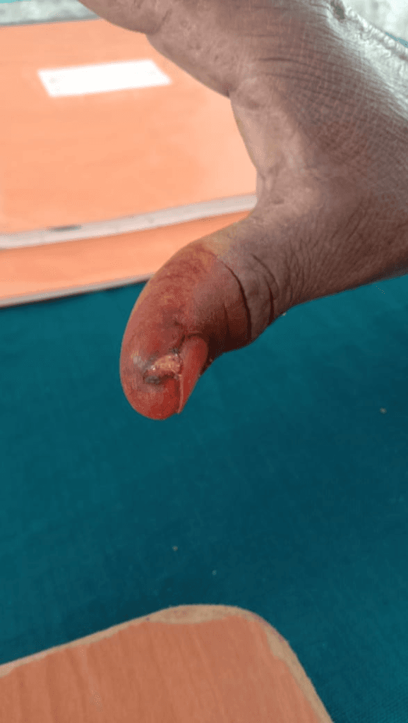 Thumb Pulp Ulceration & Severe Paronychia Healing - Before Homeopathy Treatment